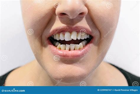 Crooked Teeth In The Anterior Part Of The Patient At The Reception Of