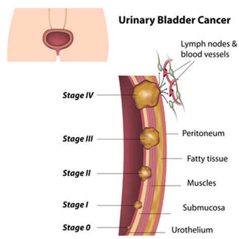 Diterbitkan olehriswan ronaldo telah diubah 5 tahun yang lalu. BLADDER CANCER - Urinary Health Journal