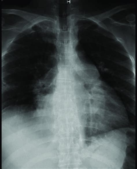 Chest Radiography Showing Enlarged Pulmonary Tract And Dilation Of The