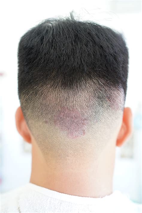 Scalp Psoriasias Back Of Head Psoriasis Cure Now
