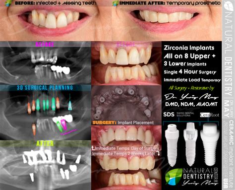 Ceramic All On 468 Zirconia Dental Implants