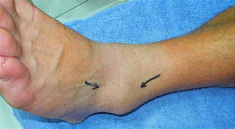 The Efficacy Of Manual Joint Mobilisationmanipulation In Treatment Of