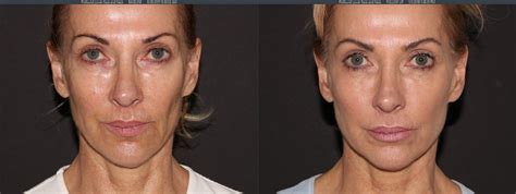 Profound Rf Skin Tightening And Sculpting Live Young Medical