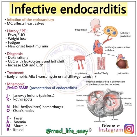 Infective Endocarditis Medizzy