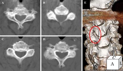 Bow Hunters Stroke Due To Instability At The Uncovertebral C34 Joint