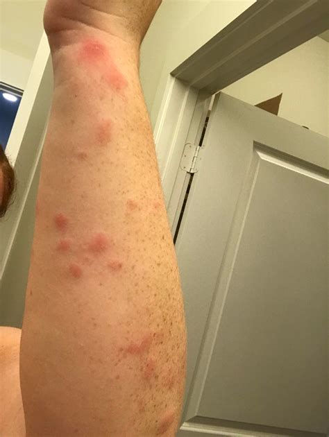 Are These Bed Bug Bites This Happened Overnight I Have Scoured My