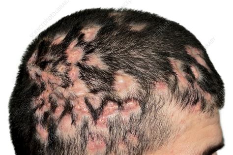 Dissecting Folliculitis On The Scalp Stock Image C0119521