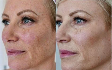 Bbl® Laser Skin Rejuvenation Before And After Photo Gallery Toronto On Ford Plastic Surgery