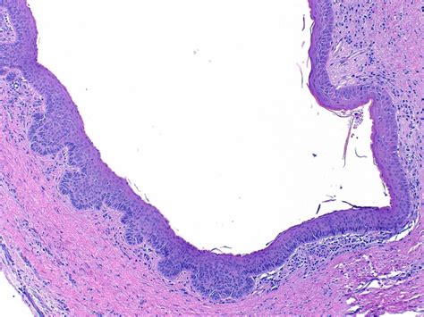 Histologic Image Of An Odontogenic Keratocystkeratocystic Odontogenic