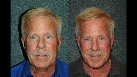 male facelift before and after necklift and rhinoplasty 60 year old man dr andrew jacono