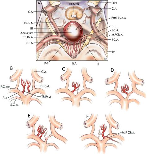 aneurysms the neurosurgical atlas