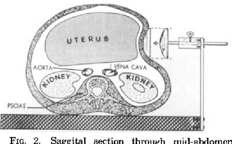 Figure 2 From A Self‐supporting Device For Continuous Left Uterine
