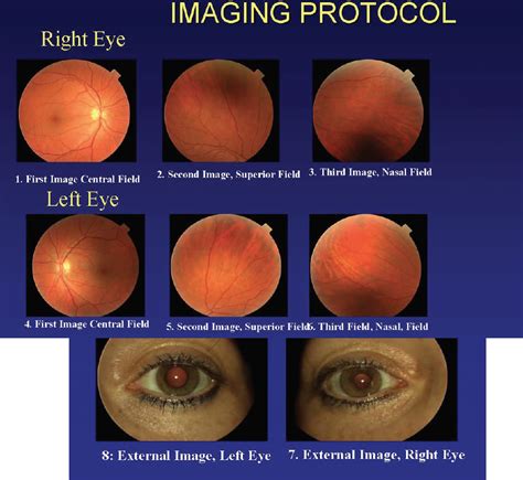 Improving Veterans Ocular Health Retina Today