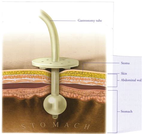 Our Life And Such The Gastrostomy Tube