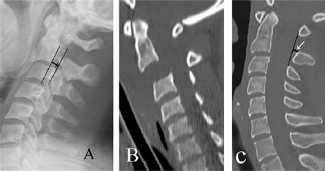 Three Patients With Hangmans Fracture A A Lateral Cervical Spine
