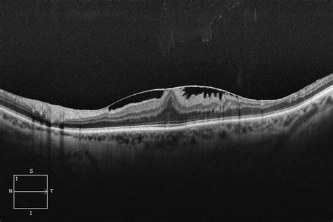 Epiretinal Membrane Erm Qld Eye And Retina Specialists Brisbane