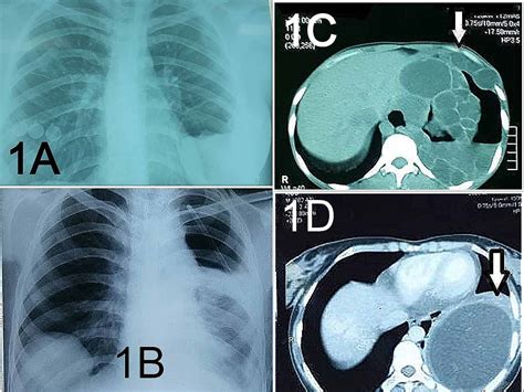Cureus Management Outcome In Simple And Complex Hydatid Cysts Of Lung