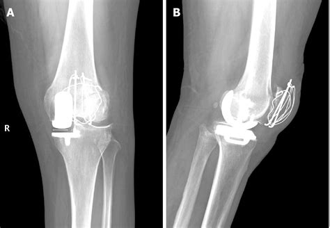 Patella Fractures Knee New York Fracture Care