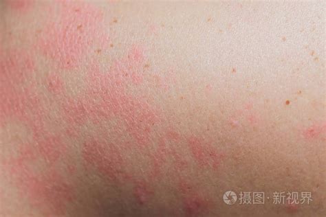 闭合过敏性皮疹 周围人的皮疹皮炎问题 过敏性皮疹和健康问题的背景图照片 正版商用图片14zfcq 摄图新视界