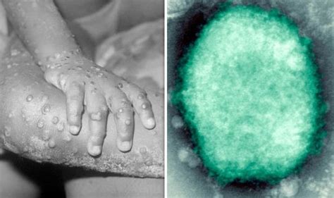 Monkeypox Virus Monkeypox Virus Diagnosed In Uk How Does It Spread