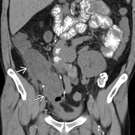 Pancreatic Transplantation Radiology Key