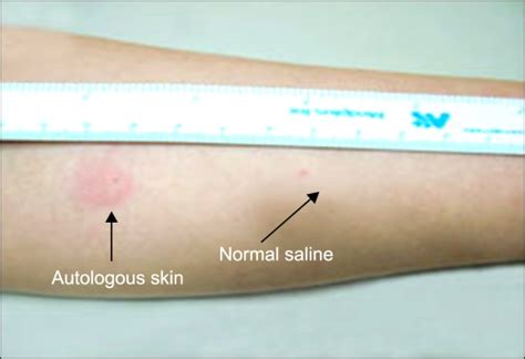 Positive Results Of Autologous Serum Skin Test The Serum Injected Site