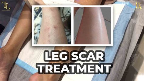 Dark Scars On Leg Scar Treatment ⚡️ Youtube