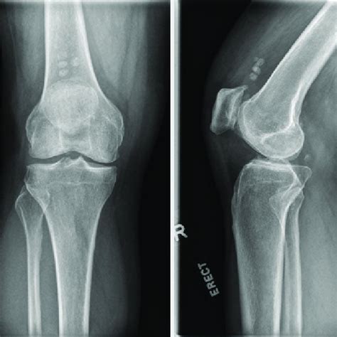 Plain Radiograph Of The Right Knee Anteroposterior A And Lateral B