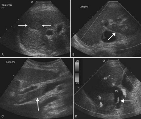 Ultrasound Of The Liver Biliary Tract And Pancreas Clinical Gate