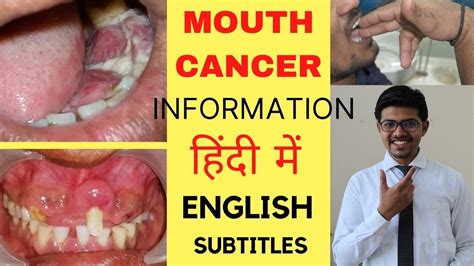 Mouth Cancer Information In Hindi English Subtitles By Dr Akash Shah
