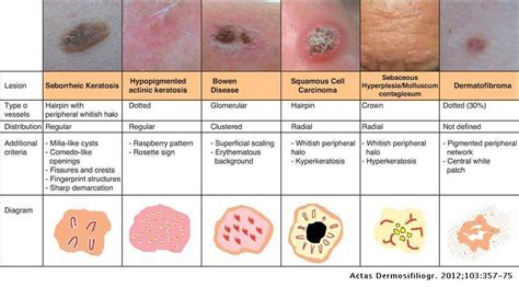 Vascular Patterns In Dermoscopy Actas Dermo Sifiliográficas