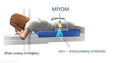 Ameliyatsiz Miyom Tedavisi Embolizasyon RF Ablasyon HIFU
