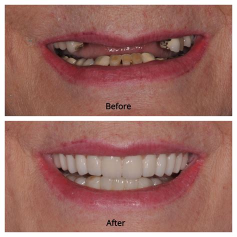 Full Dental Implants Before And After