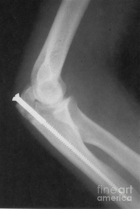 Broken Arm With Metal Pin X Ray Photograph By Science Source Fine