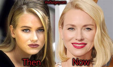 Naomi Watts Plastic Surgery Before And After Botox Nose Job Pictures