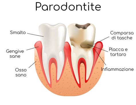 Parodontite Cause Sintomi E Cura Valori Normali