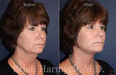facelift before and after photo gallery