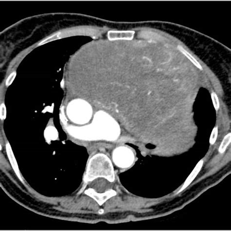 Chest Ct Scan With Contrast Medium Revealing An Extensive Vascularized