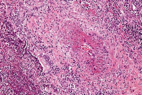Granulomatosis With Polyangiitis Libre Pathology