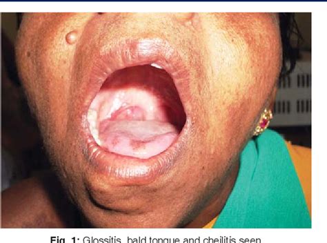 A Case Of Plummer Vinson Syndrome Esophageal Web Dysphagia Treated By