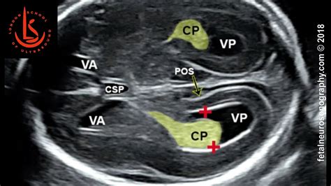 Fetal Lateral Ventricle Measurements How To Measure Posterior