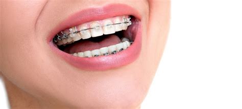 How Damon Braces Compare To Other Treatments Euro Dental Care