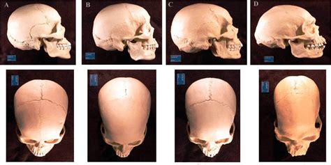 Photographs Of Phenotypic Variability In Skull Shape By Geographic