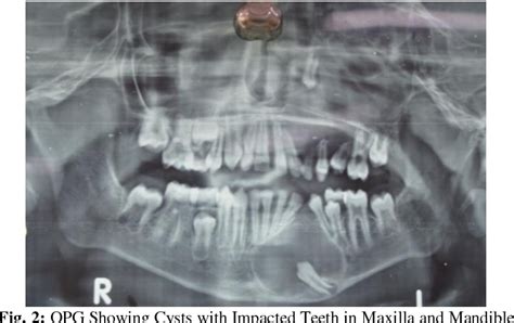 Figure 2 From Dentigerous Cyst Of Maxilla And Mandible Associated With