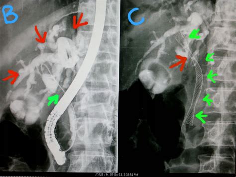 Ercp And Egd Cholangiocarcinoma Below The Confluence