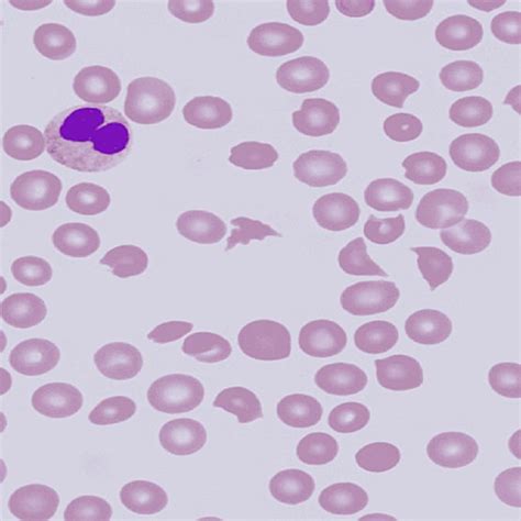 Peripheral Blood Smear Revealing Normocytic Normochromic Anemia Marked