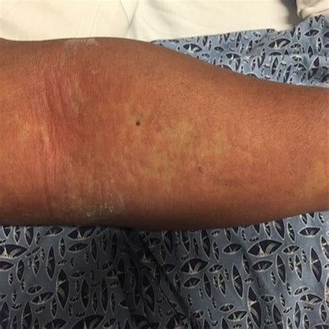 Drug Rash With Eosinophilia And Systemic Symptoms Dress Caused By