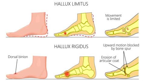 Hallux Rigidus Hallux Limitus Explained By A Foot Specialist