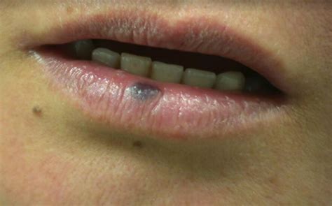 Skin Cancer Moles On Lips Lipstutorial Org