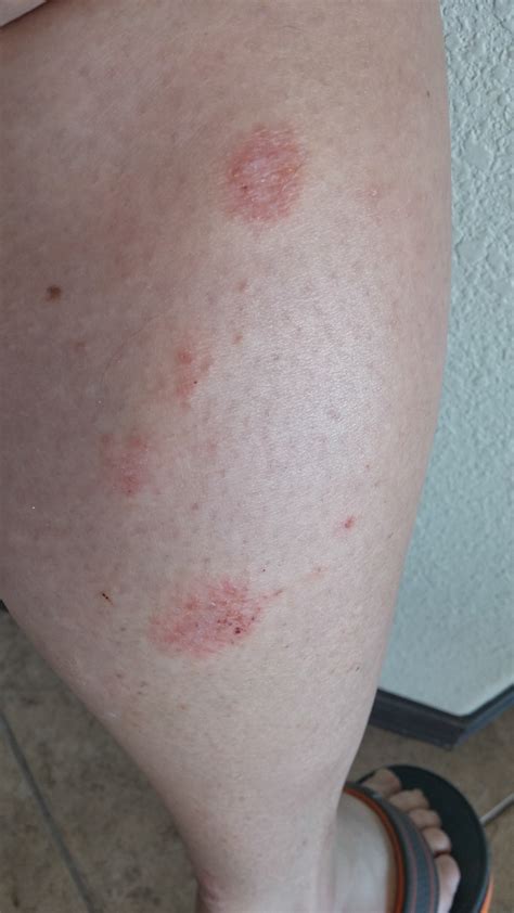 100 Bizarre Intense Itching Rash Hive Like Red Patches On Legs Arms